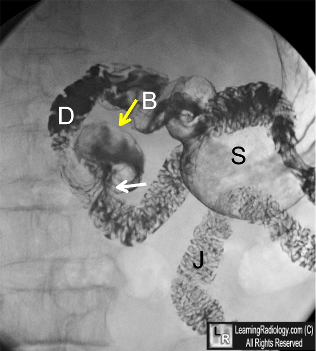 Duodenal Diverticulum